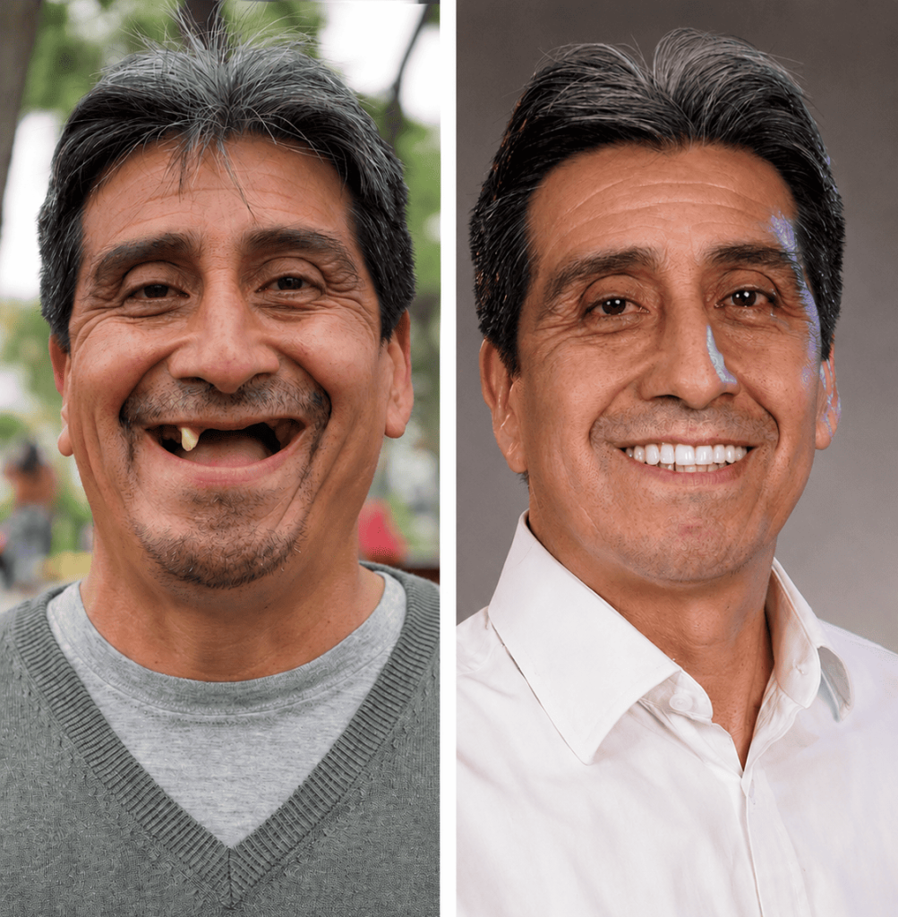 paciente-implantes-dentales-molar32