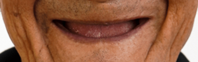 Antes y después de tratamiento de implantes dentales en paciente de Molar32 Lima 1