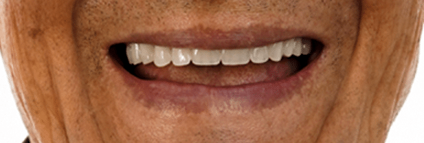 Antes y después de tratamiento de implantes dentales en paciente de Molar32 Lima 2
